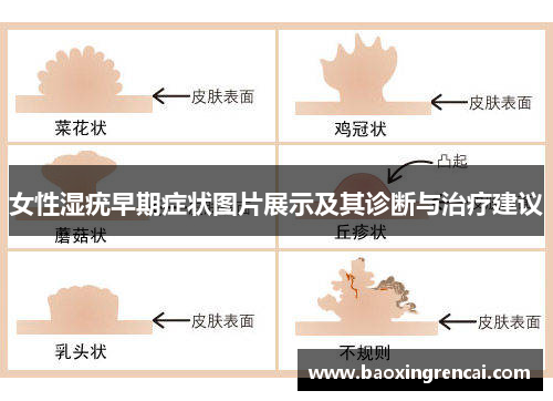 女性湿疣早期症状图片展示及其诊断与治疗建议